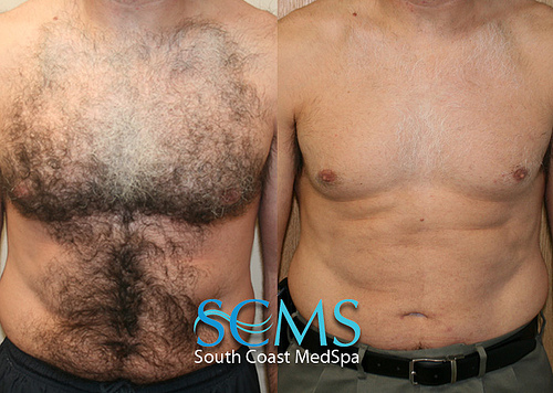 Post image for Laser Hair Removal – What You Need To Know.