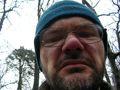 rosacea